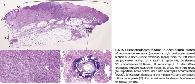 Wound Tumor Virus : 伤口肿瘤病毒