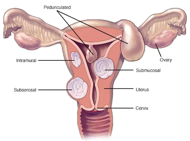 Uterine Fibroid Embolization : 子宫肌瘤栓塞