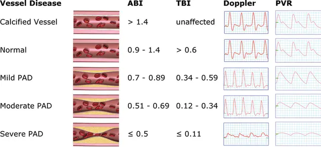 Arterial Stiffness and Calcifications in Incident Renal Transplant Recipients : 肾移植受者的动脉硬化和钙化