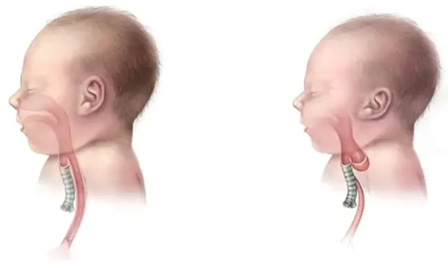 Oesophageal Atresia Research Auxiliary : 食管闭锁研究辅助