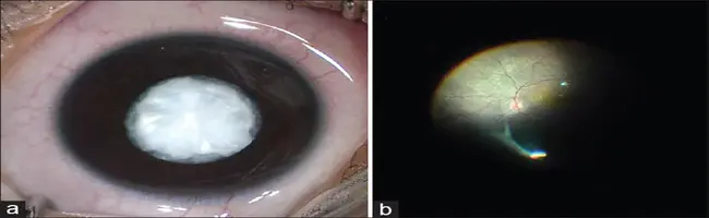 Cataract and Primary Eye Care : 白内障和初级眼科护理