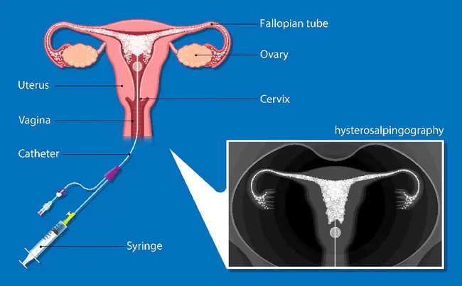 HysteroSalphingoGraphy : 子宫输卵管造影