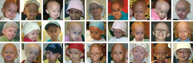 Progeria Research Foundation : 早产儿研究基金会