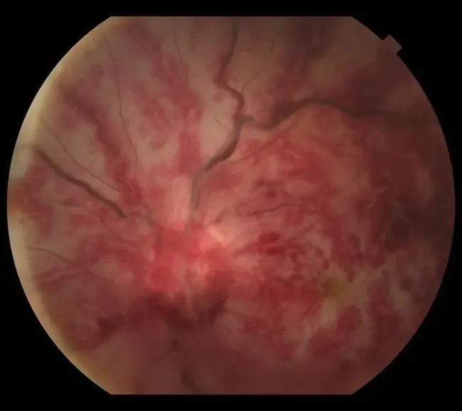 Ophthalmic and Physiological Optics : 眼科和生理光学