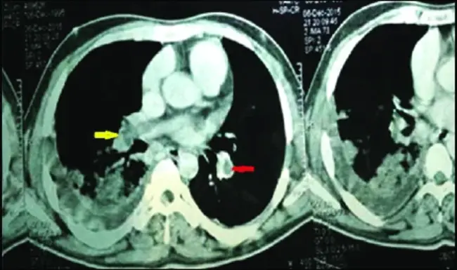 Major Aortopulmonary Collateral Arteries : 主主动脉肺侧支动脉