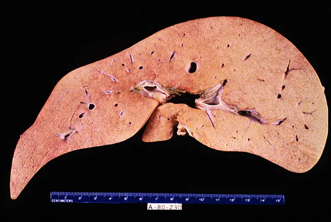 Hepato Pancreatico Biliary : 肝胰胆管