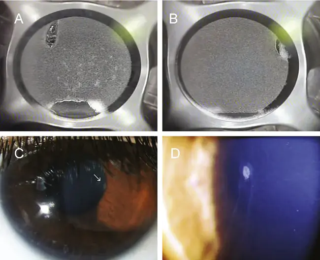 Intralase Enabled Keratoplasty : 激光角膜移植术