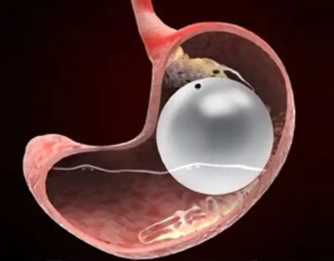 BioEnterics Intragastric Balloon : 胃内气囊