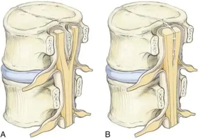 Incomplete Spinal Cord Injury : 不完全性脊髓损伤