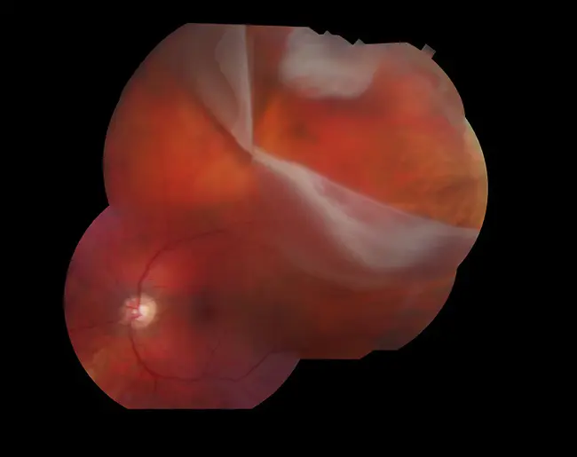 Retina Vitreous Center : 视网膜玻璃体中心