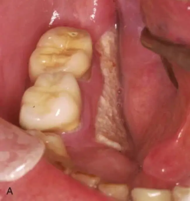 Bisphosphonate Osteonecrosis of the Jaw : 双磷酸盐颌骨坏死