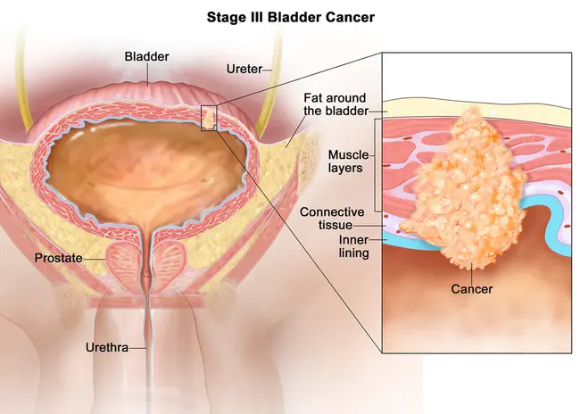 Bladder Female Transitional Carcinoma : 膀胱女性移行癌