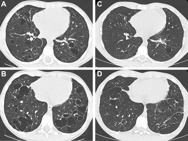 Pulmonary Langerhans Cell Histiocytosis : 肺郎格罕细胞组织细胞增多症