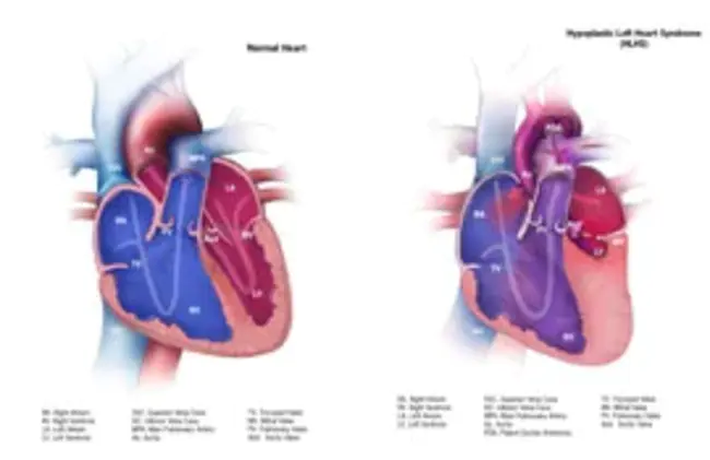 Hypoplastic Left Heart Syndrome : 左心发育不良综合征