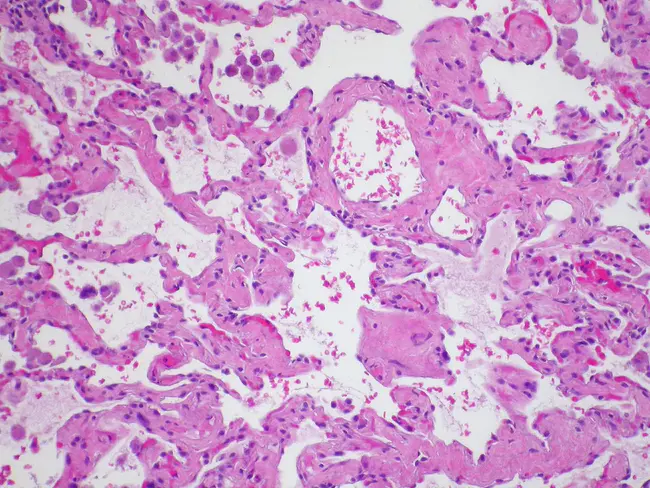 Smoking-related Interstitial Fibrosis : 吸烟相关性间质纤维化