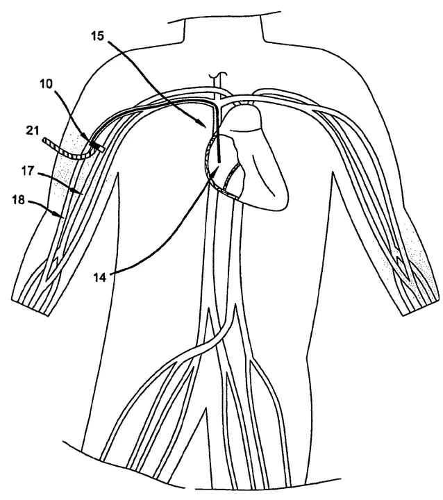 Arterio-Venous Oxygen : 动静脉氧