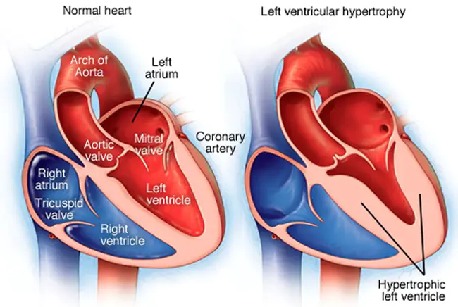 Left Ventricular Noncompaction Cardiomyopathy : 左心室致密化不全心肌病