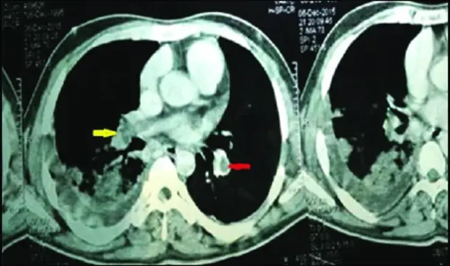 Major Aortopulmonary Collateral Artery : 主要主肺侧支动脉