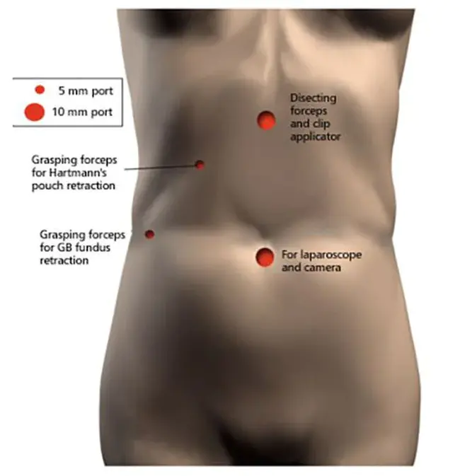 Hand assisted laparoscopic colectomy : 手助腹腔镜结肠切除术