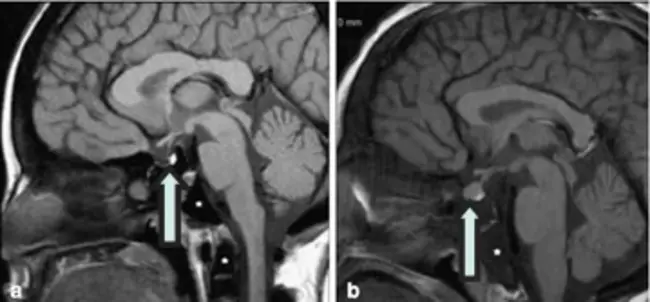 Limbic Hypothalamic Pituitary Adrenal : 下丘脑边缘-垂体-肾上腺