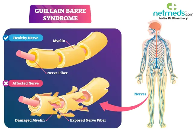 Guillain Barre Syndrome : 格林巴利综合症