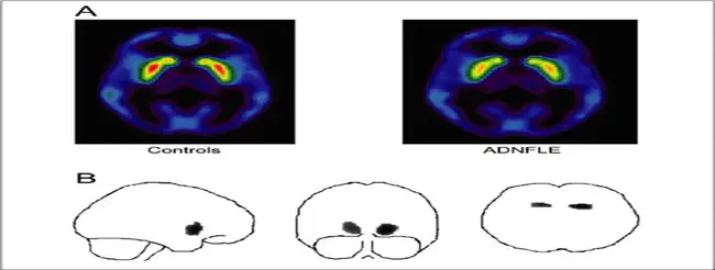 Dopamine Responsive Dystonia : 多巴胺反应性肌张力障碍