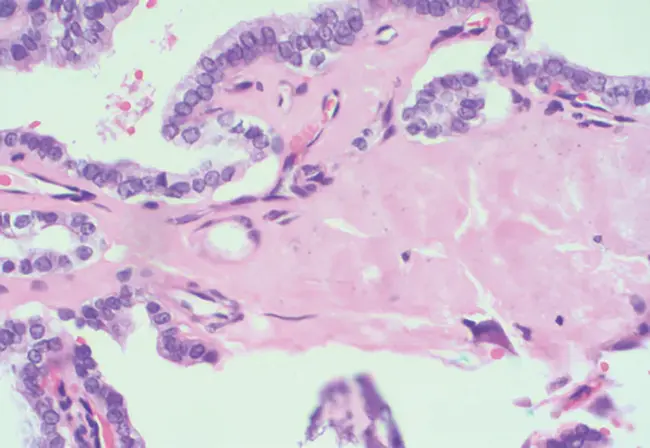 Papillary Renal Cell Carcinoma : 乳头状肾细胞癌