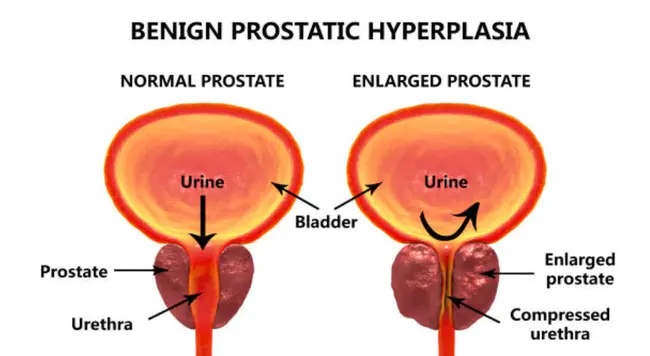 Benign prostate hyperplasia : 良性前列腺增生