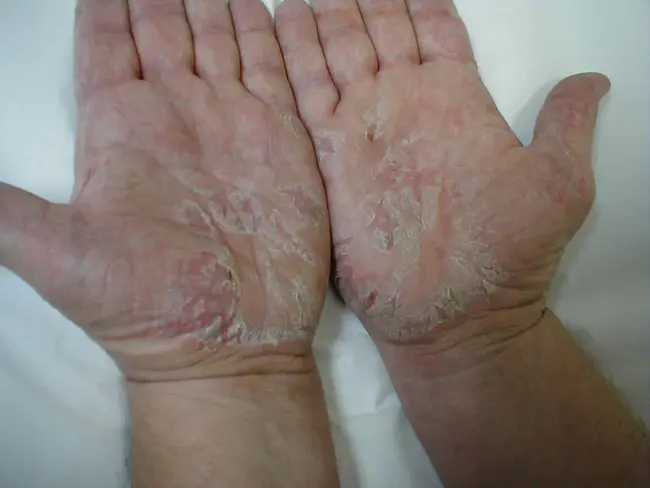 Atopic Dermatitis Quickscore : 特应性皮炎流沙