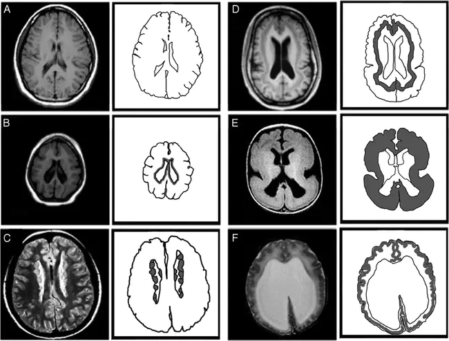 Cortical Malformation Cephalic Disorder : 脑皮质畸形