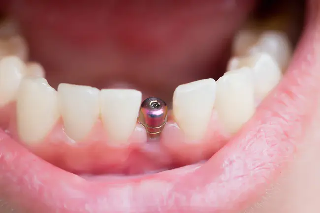 Fellow American Dental Implant Association : 美国牙种植协会会员