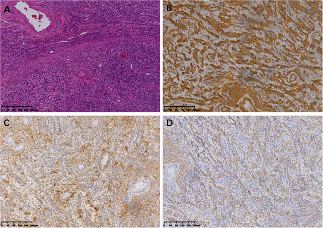 Intratubular Germ Cell Tumor : 管状生殖细胞瘤