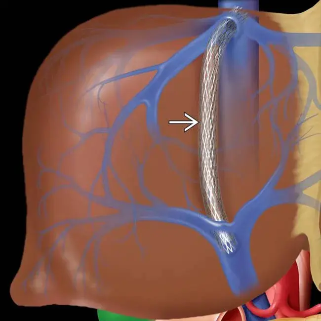 Transhepatic Arterial Infusion Chemotherapy : 经肝动脉灌注化疗