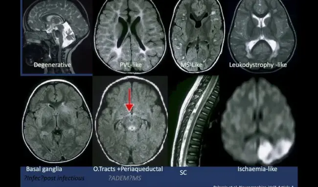 Mitochondrial Encephalomyopathy Lactic Acidosis and Strokelike : 线粒体脑肌病乳酸性酸中毒和频闪样