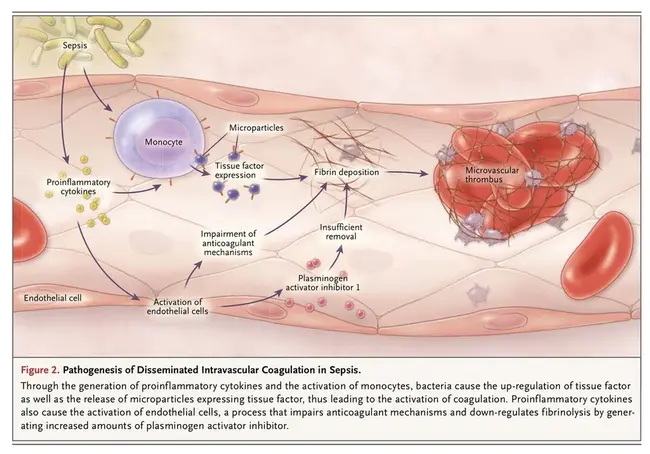 Dissiminated Intravascular Coagulation : 弥散性血管内凝血