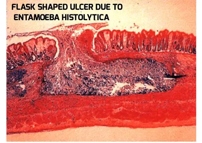 Non Ulcer Dyspepsia : 非溃疡性消化不良