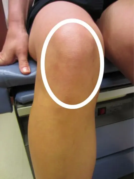 Patello Femoral Joint : 髌股关节