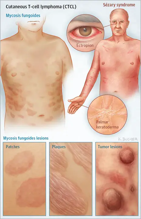 Cutaneous B Cell Lymphoma : 皮肤B细胞淋巴瘤