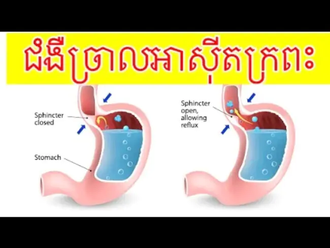 Gastro Esophageal Reflux : 胃食管反流