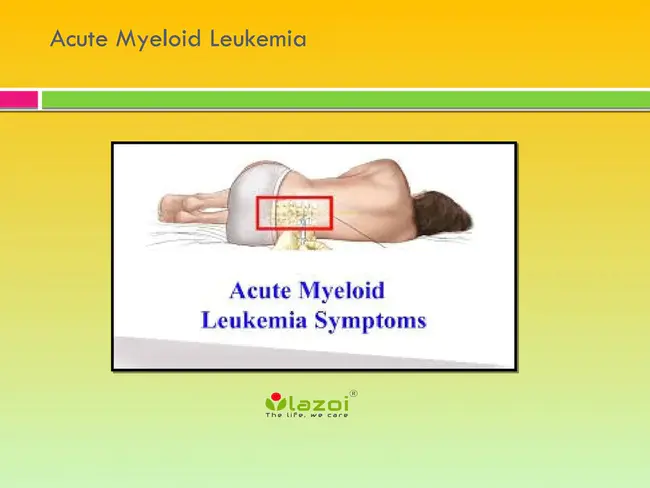 Acute Myeloid Leukemia : 急性髓性白血病