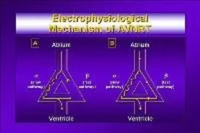 AtrioVentricular Re-entry Tachycardia : 房室折返性心动过速