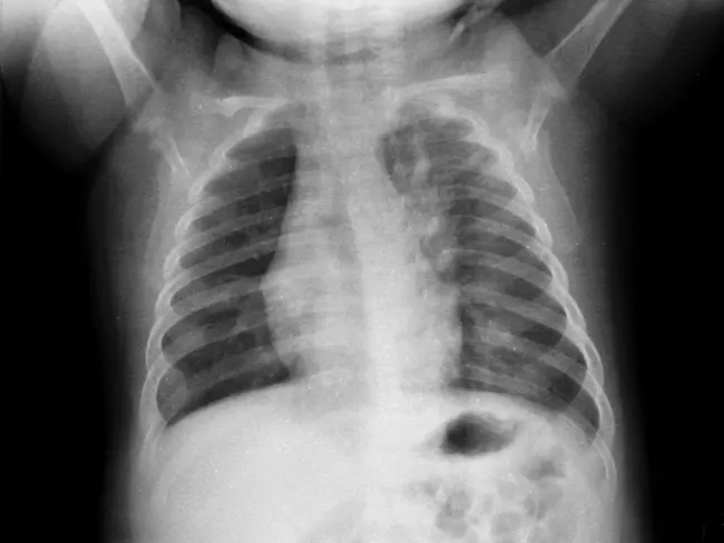 Bronchiolitis ObliteransOrganizing Pneumonia : 闭塞性细支气管炎