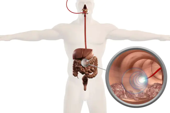 Endoscopic Retrograde Cholangiopancreatogram : 内镜逆行胰胆管造影