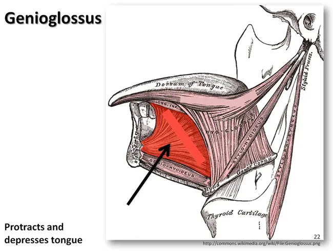 Genioglossus Advancement (oral surgery) : Genioglosus进展（口腔外科）