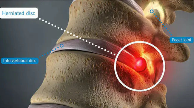 Herniated Nucleus Pulposis (herniated disc) : 髓核突出症（椎间盘突出症）