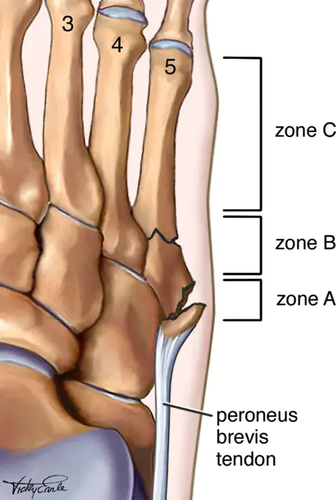 Metatarsal Phalangeal Joint (foot) : 跖骨指骨关节（脚）