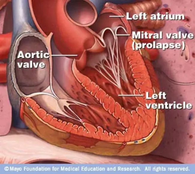 Mitral Valve Valvuloplasty (valve repair) : 二尖瓣成形术（瓣膜修复）