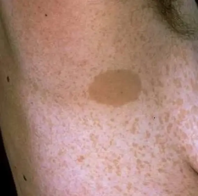 Axillary Lymph Node Dissection : 腋窝淋巴结清扫