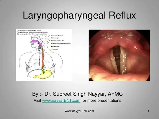 Laryngeal Pharyngeal Reflux : 喉咽反流