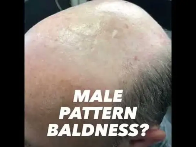 Direct Hair Transplantation : 直接毛发移植